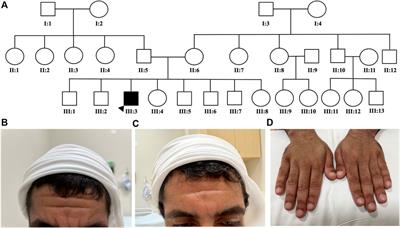 Etoricoxib as a treatment of choice for patients with SLCO2A1 mutation exhibiting autosomal recessive primary hypertrophic osteoarthropathy: A case report